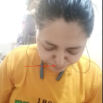 CSF Rhinorrhea Getting cured